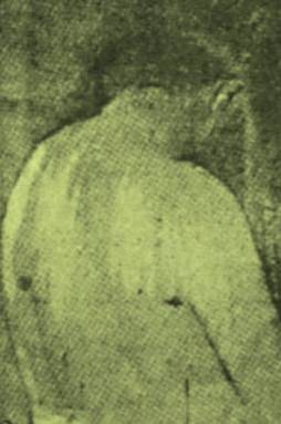 Ferimentos de Antonio Silvino após a sua captura.